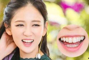 明星网红修复牙齿,揭秘明星美齿秘籍